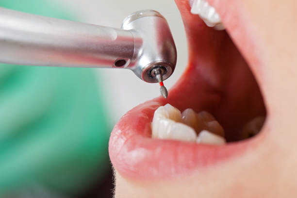 Best Emergency Tooth Extraction in Franklin, TN